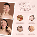 Acne Cure Lotion (20ml)